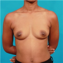 Breast Augmentation Before Photo by Michael Bogdan, MD, MBA, FACS; Grapevine, TX - Case 32252