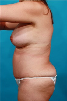 Tummy Tuck After Photo by Michael Bogdan, MD, MBA, FACS; Grapevine, TX - Case 32254