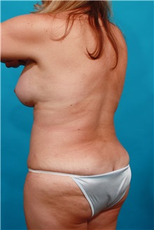 Tummy Tuck After Photo by Michael Bogdan, MD, MBA, FACS; Grapevine, TX - Case 32254