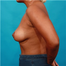 Breast Lift After Photo by Michael Bogdan, MD, MBA, FACS; Grapevine, TX - Case 32257