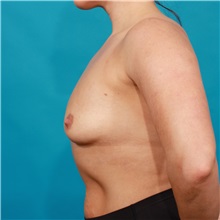 Breast Augmentation Before Photo by Michael Bogdan, MD, MBA, FACS; Grapevine, TX - Case 32258