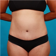 Tummy Tuck After Photo by Michael Bogdan, MD, MBA, FACS; Grapevine, TX - Case 32260