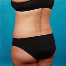 Tummy Tuck After Photo by Michael Bogdan, MD, MBA, FACS; Grapevine, TX - Case 32260