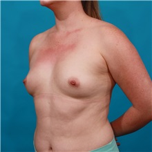 Breast Augmentation Before Photo by Michael Bogdan, MD, MBA, FACS; Grapevine, TX - Case 32261