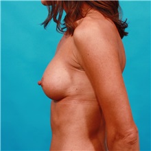 Breast Augmentation After Photo by Michael Bogdan, MD, MBA, FACS; Grapevine, TX - Case 32262