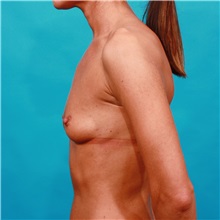 Breast Augmentation Before Photo by Michael Bogdan, MD, MBA, FACS; Grapevine, TX - Case 32262