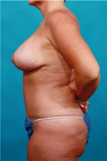 Tummy Tuck After Photo by Michael Bogdan, MD, MBA, FACS; Grapevine, TX - Case 32264