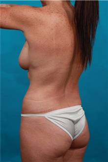 Tummy Tuck After Photo by Michael Bogdan, MD, MBA, FACS; Grapevine, TX - Case 32350