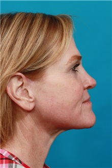 Facelift After Photo by Michael Bogdan, MD, MBA, FACS; Grapevine, TX - Case 33408