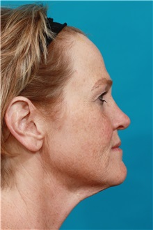 Facelift Before Photo by Michael Bogdan, MD, MBA, FACS; Grapevine, TX - Case 33408