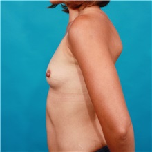 Breast Augmentation Before Photo by Michael Bogdan, MD, MBA, FACS; Grapevine, TX - Case 33431