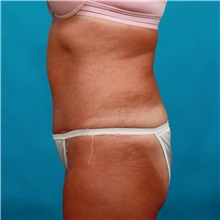 Tummy Tuck After Photo by Michael Bogdan, MD, MBA, FACS; Grapevine, TX - Case 33432