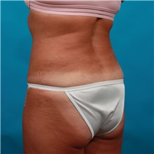 Tummy Tuck After Photo by Michael Bogdan, MD, MBA, FACS; Grapevine, TX - Case 33432