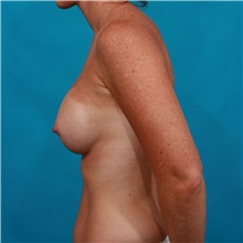 Breast Augmentation After Photo by Michael Bogdan, MD, MBA, FACS; Grapevine, TX - Case 33929