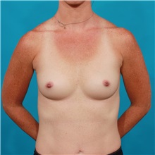 Breast Augmentation Before Photo by Michael Bogdan, MD, MBA, FACS; Grapevine, TX - Case 33929