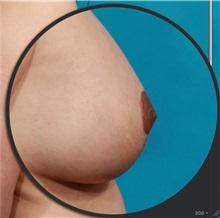 Breast Augmentation After Photo by Michael Bogdan, MD, MBA, FACS; Grapevine, TX - Case 33931