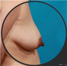 Breast Augmentation Before Photo by Michael Bogdan, MD, MBA, FACS; Grapevine, TX - Case 33931