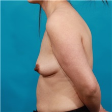 Breast Augmentation Before Photo by Michael Bogdan, MD, MBA, FACS; Grapevine, TX - Case 33931