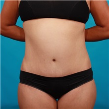 Tummy Tuck After Photo by Michael Bogdan, MD, MBA, FACS; Grapevine, TX - Case 33933