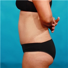 Tummy Tuck After Photo by Michael Bogdan, MD, MBA, FACS; Grapevine, TX - Case 33933