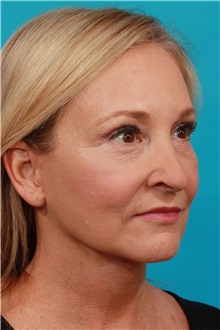Facelift After Photo by Michael Bogdan, MD, MBA, FACS; Grapevine, TX - Case 33934