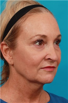 Facelift Before Photo by Michael Bogdan, MD, MBA, FACS; Grapevine, TX - Case 33934
