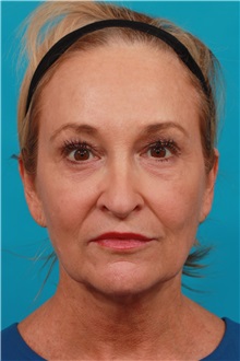 Facelift Before Photo by Michael Bogdan, MD, MBA, FACS; Grapevine, TX - Case 33934