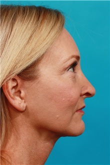 Facelift After Photo by Michael Bogdan, MD, MBA, FACS; Grapevine, TX - Case 33934