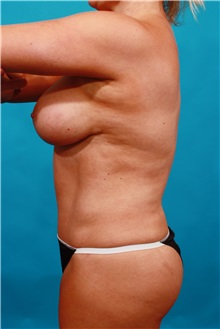 Tummy Tuck After Photo by Michael Bogdan, MD, MBA, FACS; Grapevine, TX - Case 33941