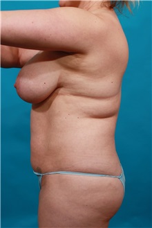 Tummy Tuck Before Photo by Michael Bogdan, MD, MBA, FACS; Grapevine, TX - Case 33941