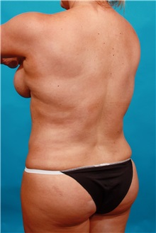 Tummy Tuck After Photo by Michael Bogdan, MD, MBA, FACS; Grapevine, TX - Case 33941