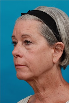 Facelift Before Photo by Michael Bogdan, MD, MBA, FACS; Grapevine, TX - Case 34113