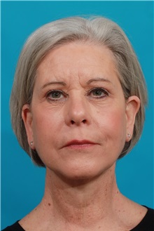 Facelift After Photo by Michael Bogdan, MD, MBA, FACS; Grapevine, TX - Case 34113