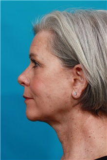 Facelift After Photo by Michael Bogdan, MD, MBA, FACS; Grapevine, TX - Case 34113