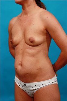 Tummy Tuck Before Photo by Michael Bogdan, MD, MBA, FACS; Grapevine, TX - Case 34114