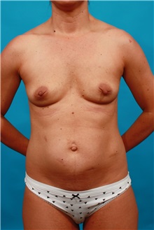 Tummy Tuck Before Photo by Michael Bogdan, MD, MBA, FACS; Grapevine, TX - Case 34114