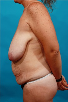 Tummy Tuck Before Photo by Michael Bogdan, MD, MBA, FACS; Grapevine, TX - Case 34116
