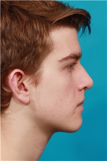 Ear Surgery Before Photo by Michael Bogdan, MD, MBA, FACS; Grapevine, TX - Case 34118