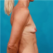 Breast Augmentation Before Photo by Michael Bogdan, MD, MBA, FACS; Grapevine, TX - Case 34124