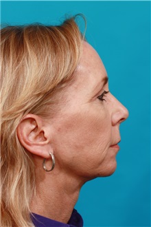 Facelift After Photo by Michael Bogdan, MD, MBA, FACS; Grapevine, TX - Case 34125