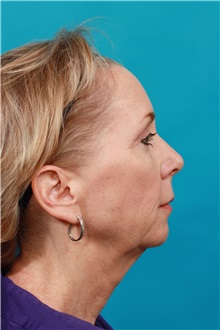 Facelift Before Photo by Michael Bogdan, MD, MBA, FACS; Grapevine, TX - Case 34125