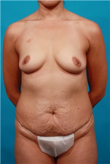 Tummy Tuck Before Photo by Michael Bogdan, MD, MBA, FACS; Grapevine, TX - Case 34196
