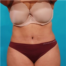 Tummy Tuck After Photo by Michael Bogdan, MD, MBA, FACS; Grapevine, TX - Case 34957