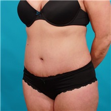 Tummy Tuck After Photo by Michael Bogdan, MD, MBA, FACS; Grapevine, TX - Case 34959
