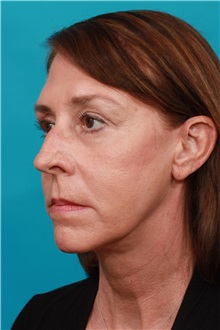Facelift After Photo by Michael Bogdan, MD, MBA, FACS; Grapevine, TX - Case 36898