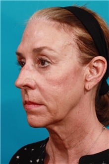 Facelift Before Photo by Michael Bogdan, MD, MBA, FACS; Grapevine, TX - Case 36898