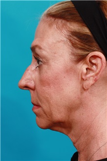 Facelift Before Photo by Michael Bogdan, MD, MBA, FACS; Grapevine, TX - Case 36898