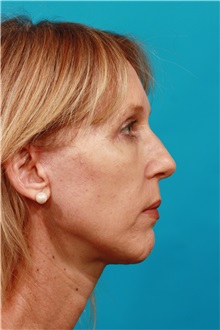 Facelift After Photo by Michael Bogdan, MD, MBA, FACS; Grapevine, TX - Case 36900