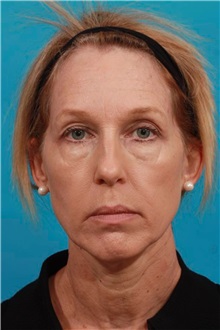 Facelift Before Photo by Michael Bogdan, MD, MBA, FACS; Grapevine, TX - Case 36900