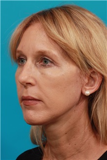 Facelift After Photo by Michael Bogdan, MD, MBA, FACS; Grapevine, TX - Case 36900